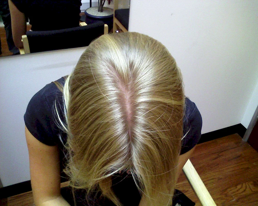Alopecia alopecia areata