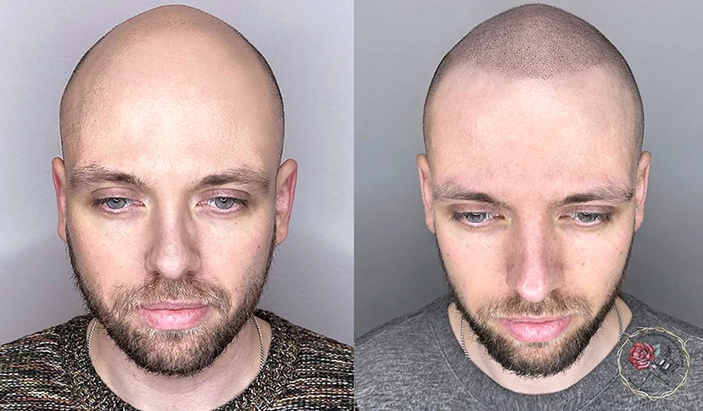 Andrey Afanasiev Trichopigmentation
