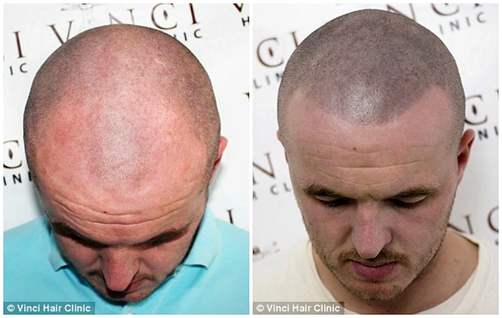 Andrei Afanasiev Trichopigmentation