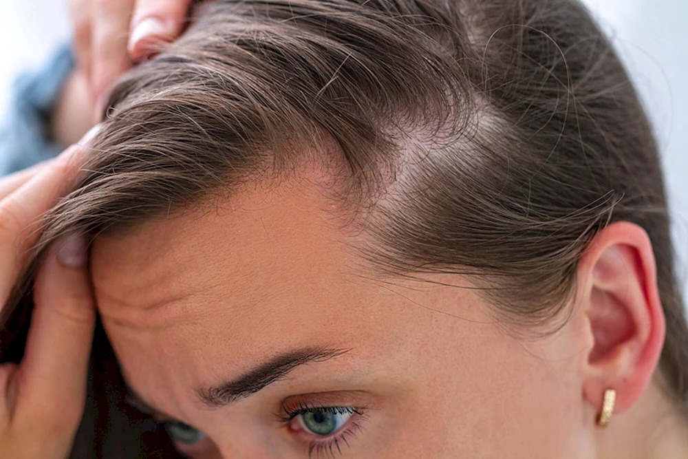 Darsonval androgenetische Alopezie