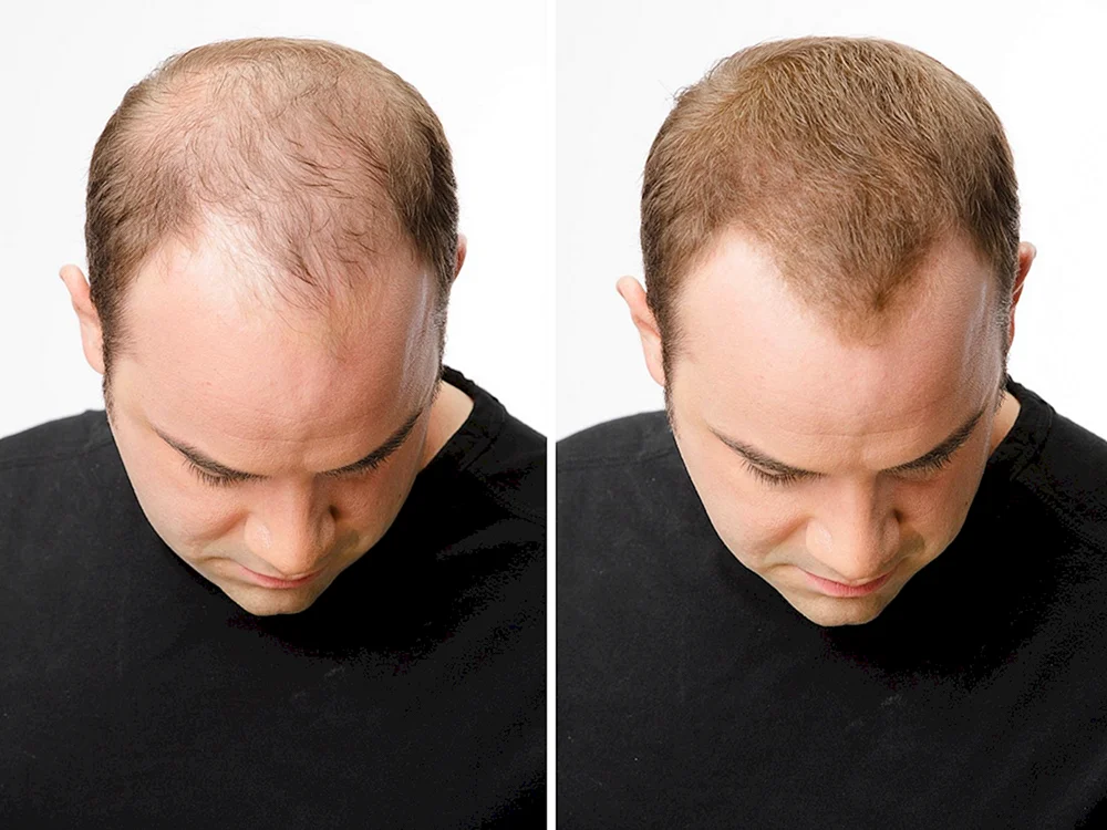 Androgenetische Alopezie Hamilton
