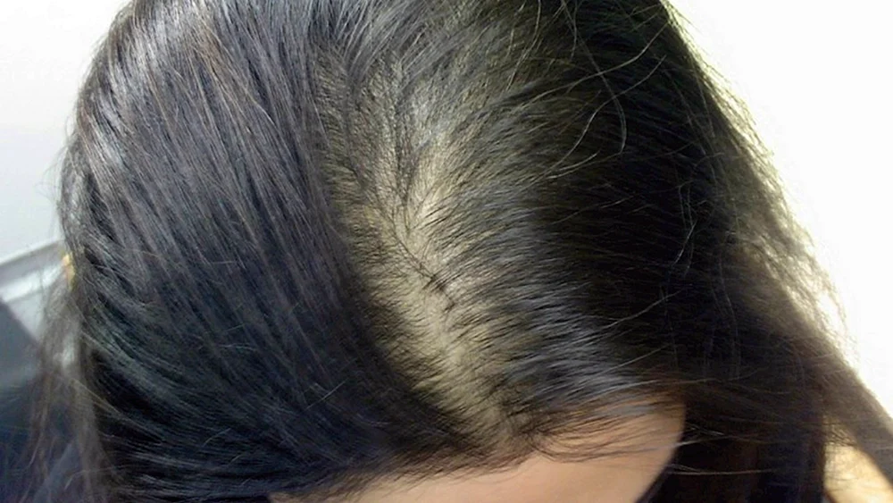 Androgenetische Alopezie