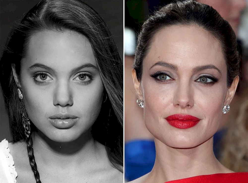 Rhinoplastik