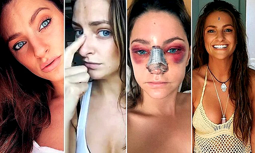 Anita Paradise vor plastischer Chirurgie