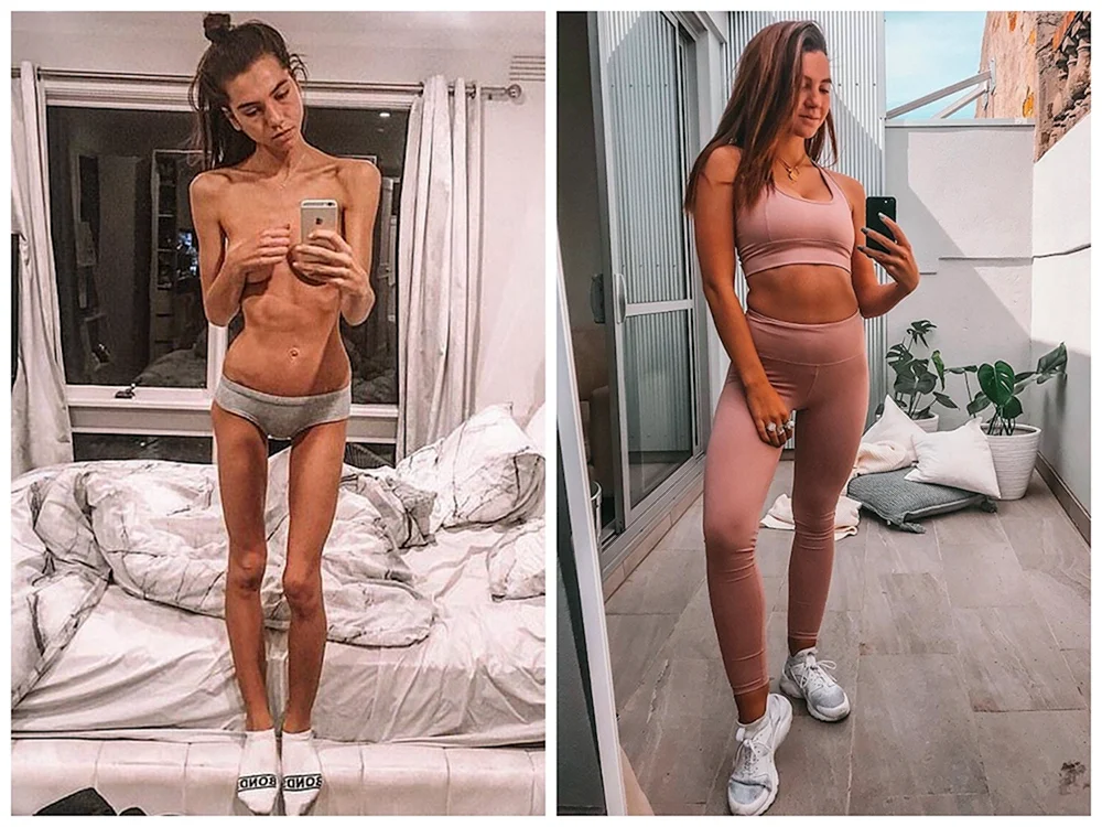 Magersucht Foto von Mädchen