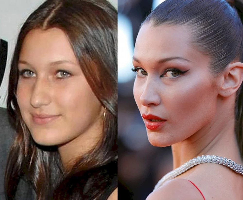 Bella Hadid Nasenkorrektur