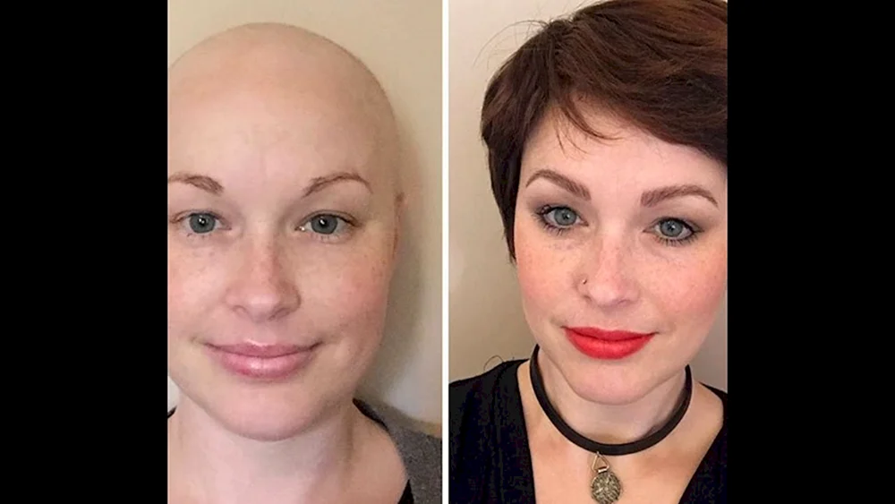 Augenbrauen nach Chemotherapie