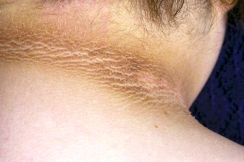 Schwarze Akanthose Acanthosis nigricans