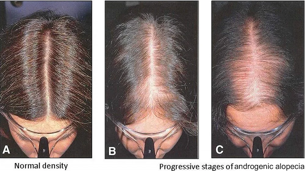 Androgenabhängige Alopezie