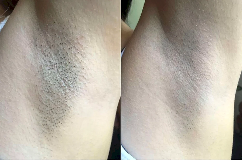 Fotoepilation elos