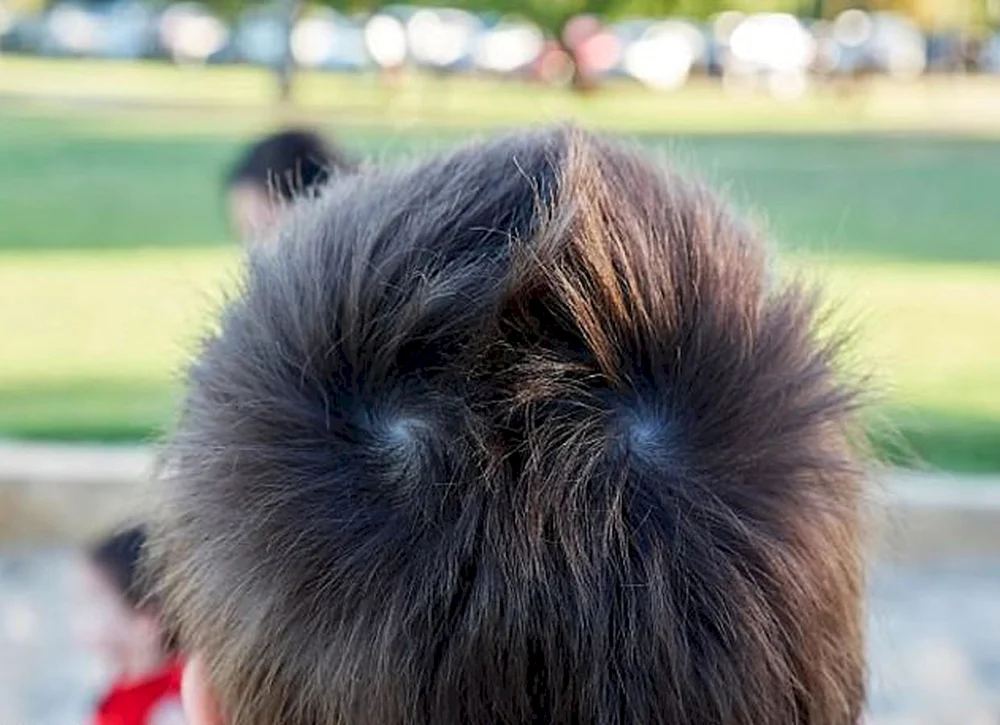 Androgenetische Alopezie Areata weiblich