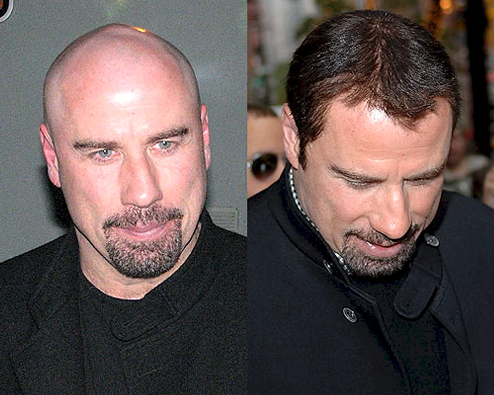 John Travolta mit Glatze