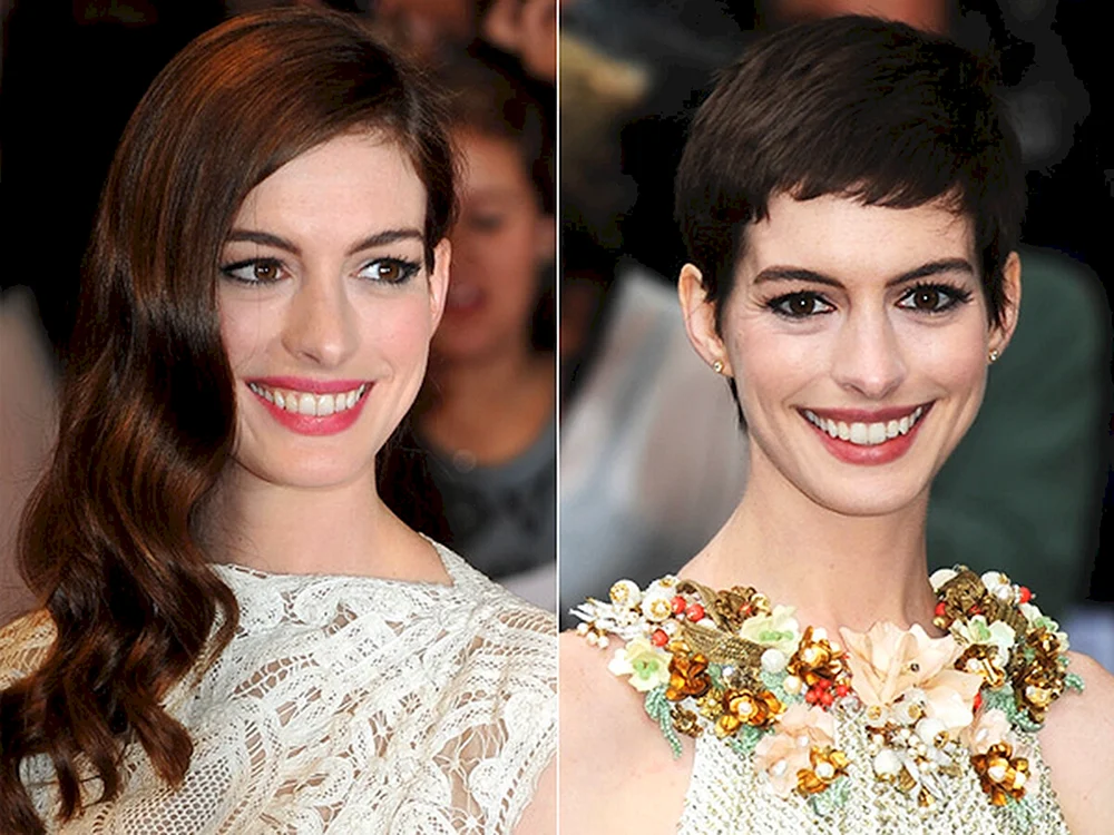 Anne Hathaway Zähne vor und nach