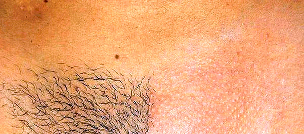 Follikulitis im Schambereich