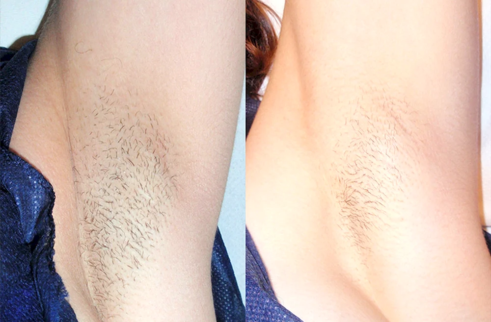 Fotoepilation von Elos