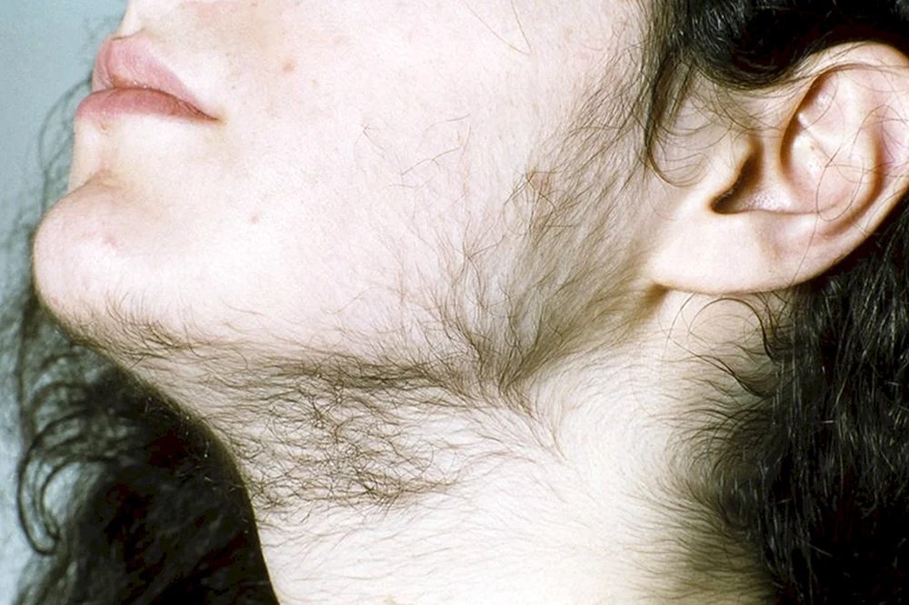 Schwarze Akanthose Acanthosis nigricans