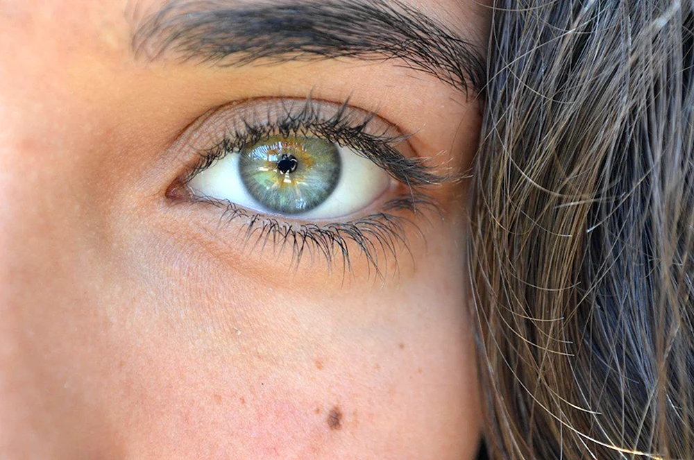 Heterochromie Augenfarbe