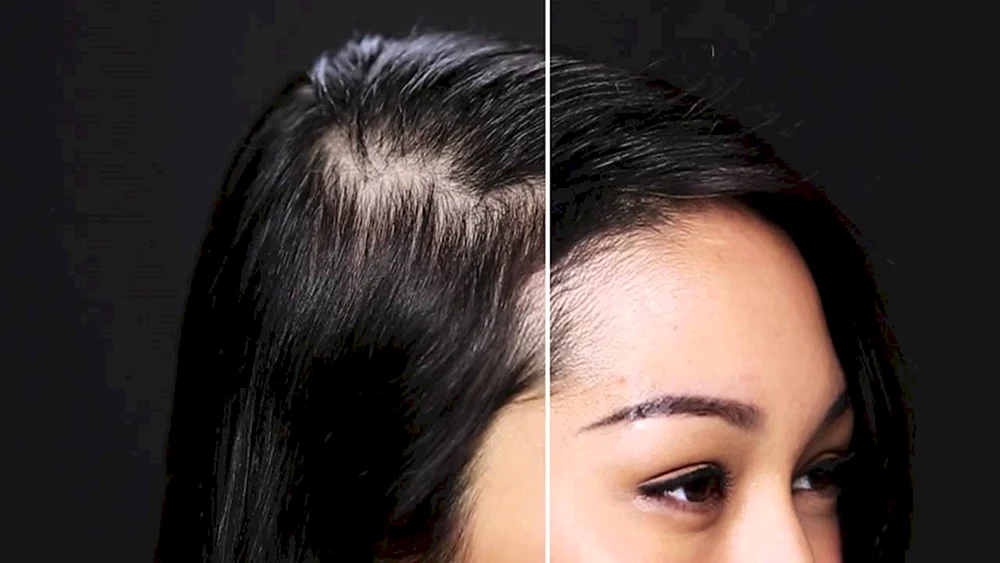 Androgenetische Alopezie