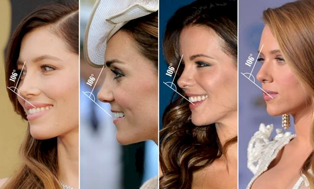 Kate Middleton Nasenkorrektur