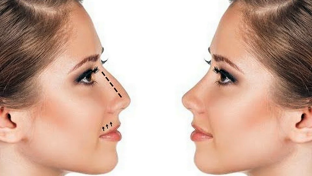 Jolie Jolie-Rhinoplastik