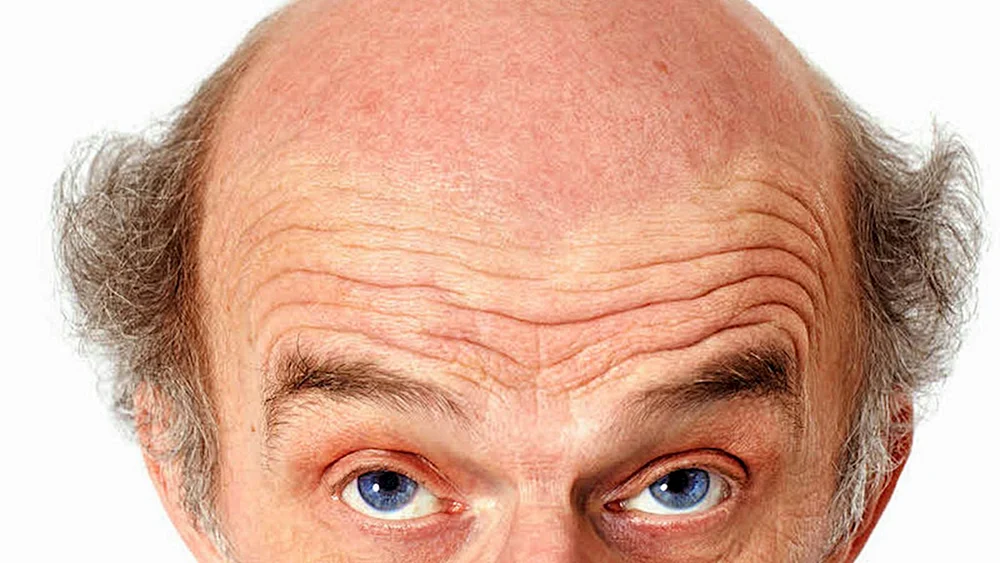 Kahle Haare an den Seiten