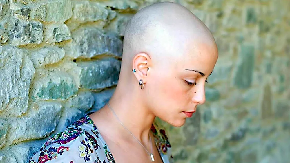 Natasha Whiteman hat eine Glatze