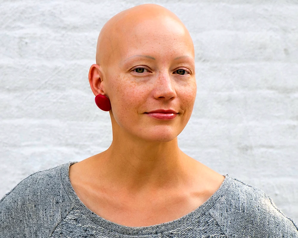 Natasha Whiteman hat eine Glatze