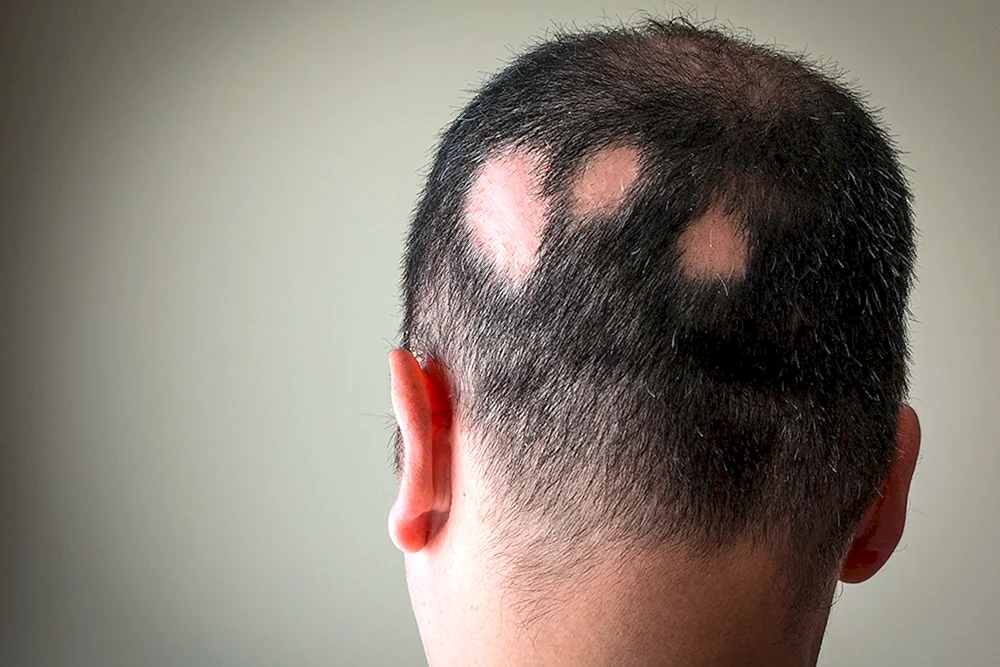 Fokale Alopezie Alopecia Areata