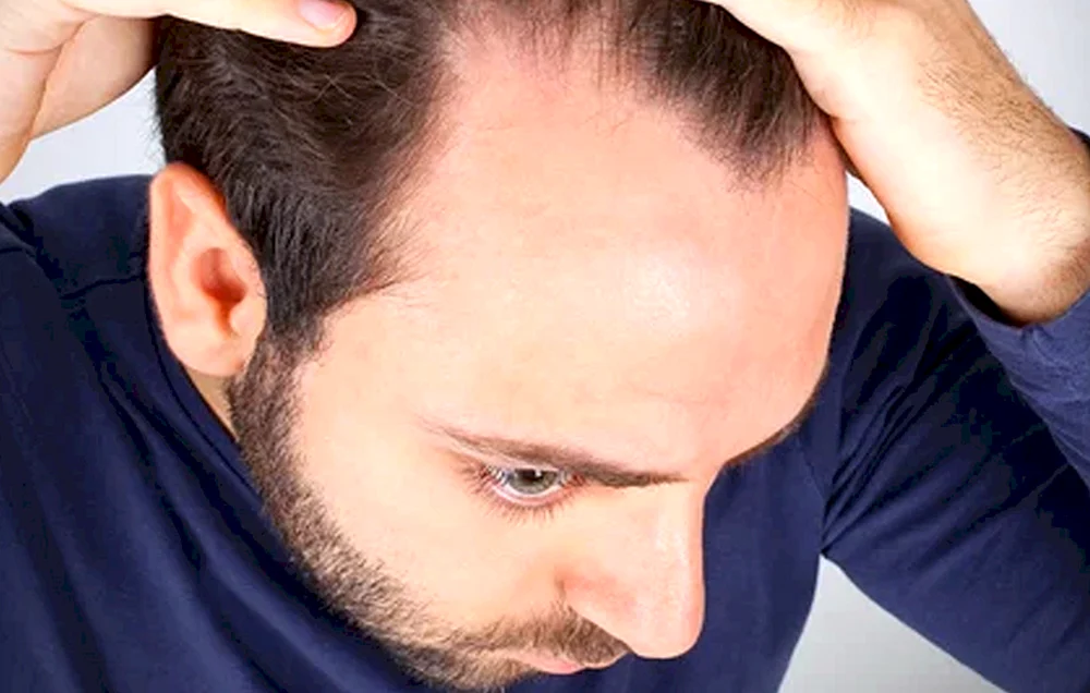 Herrenfrisuren mit Glatze