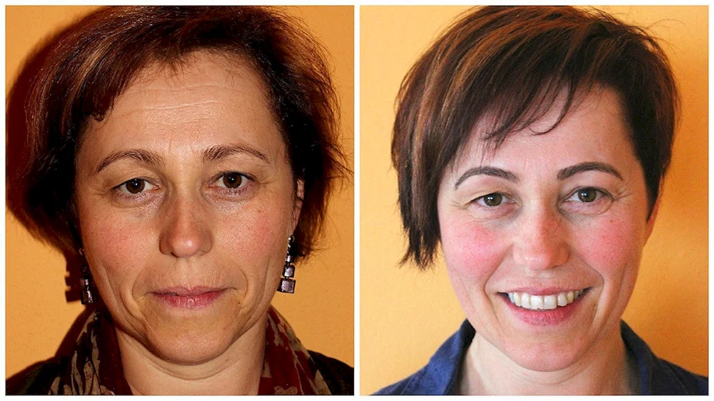 Lift. Augenbrauen-Botox vor und nach dem Foto
