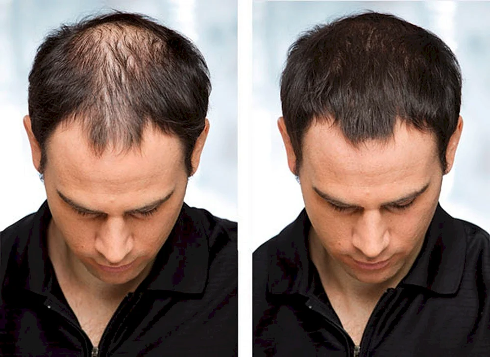 Frisuren für Männer mit Glatze