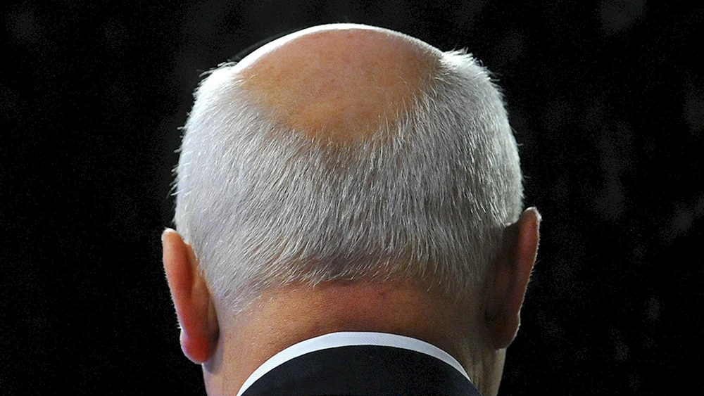 Frisuren mit Glatze