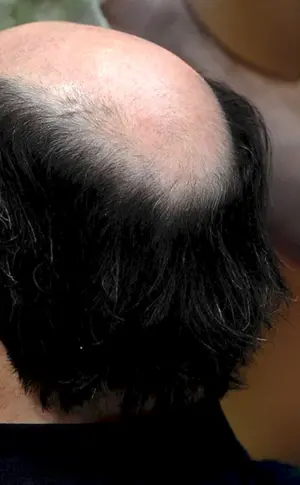 Frisuren mit Glatze