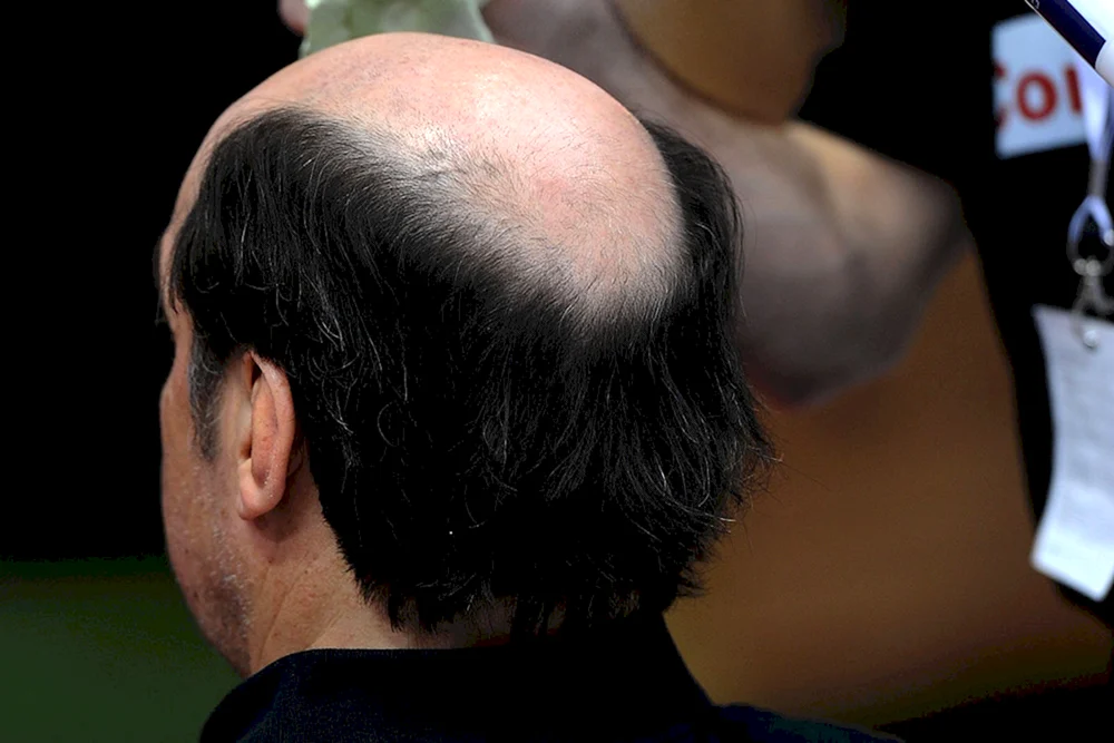 Frisuren mit Glatze