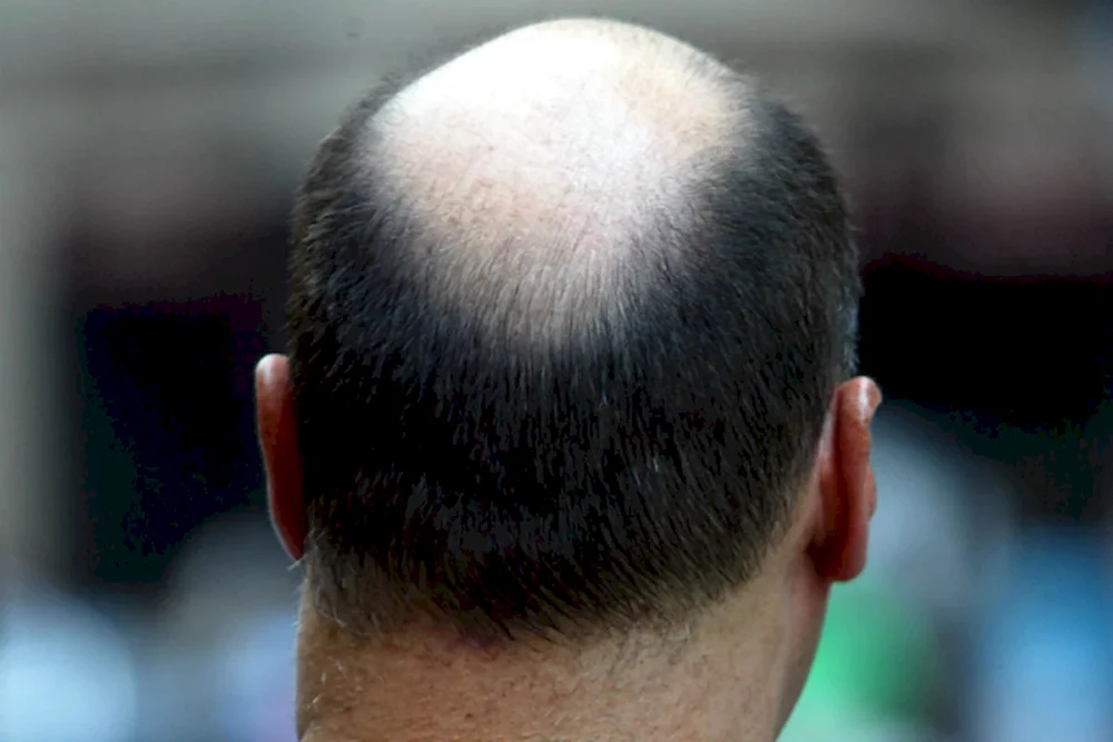 Frisuren mit Glatze am Hinterkopf