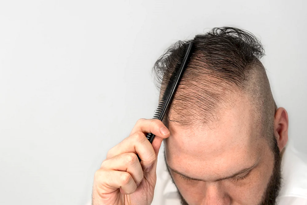 Frisuren mit Glatze