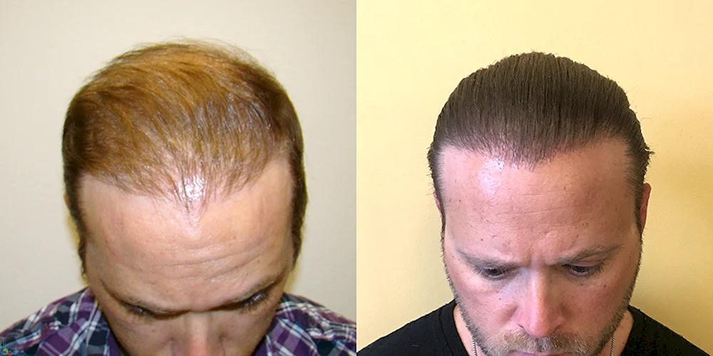 Frisuren mit Glatze