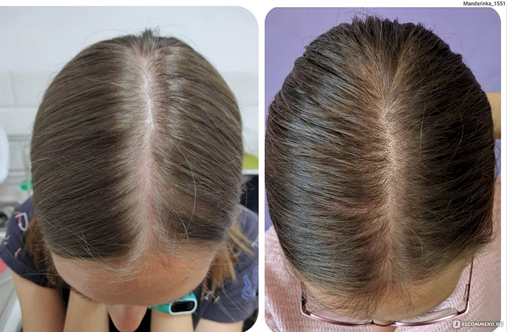 Noduläre fokale Alopezie areata