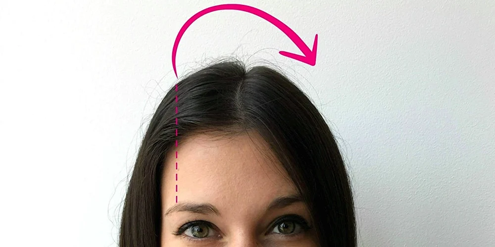 Androgenetische Alopezie