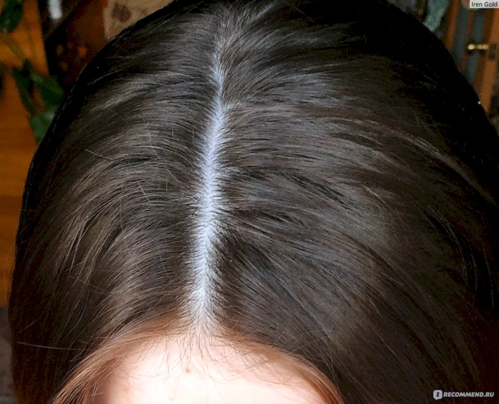 Androgenabhängiger Scheitel Alopezie
