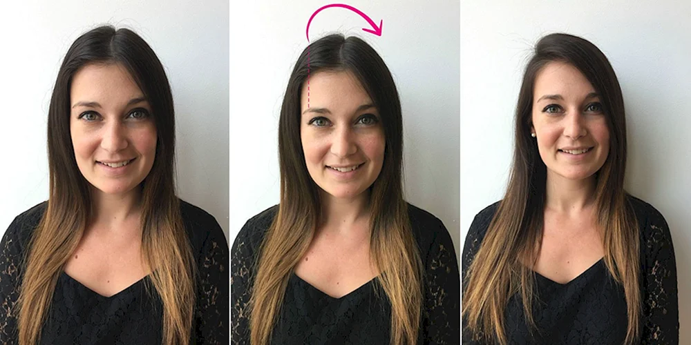 Androgenabhängige Alopezie