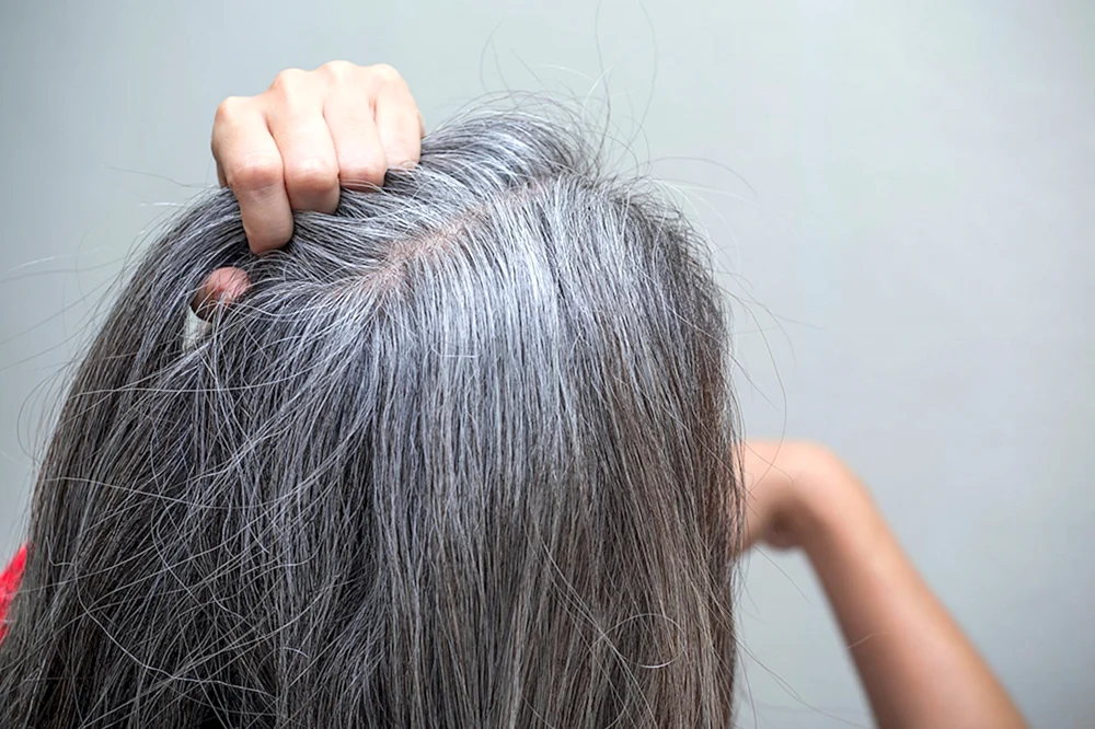 Frühes Ergrauen der Haare