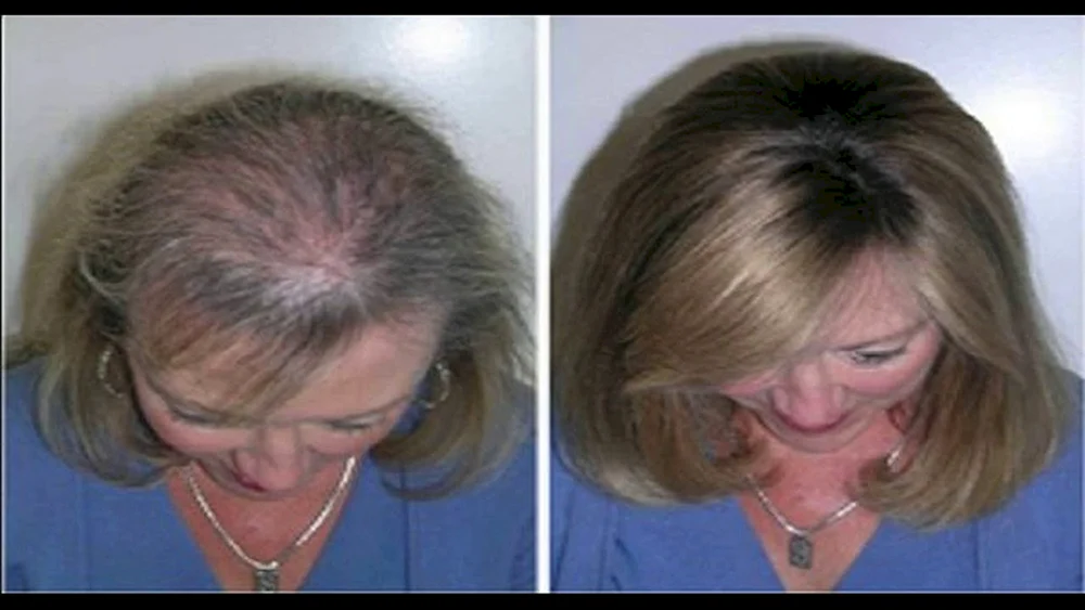 Haare nach Chemotherapie