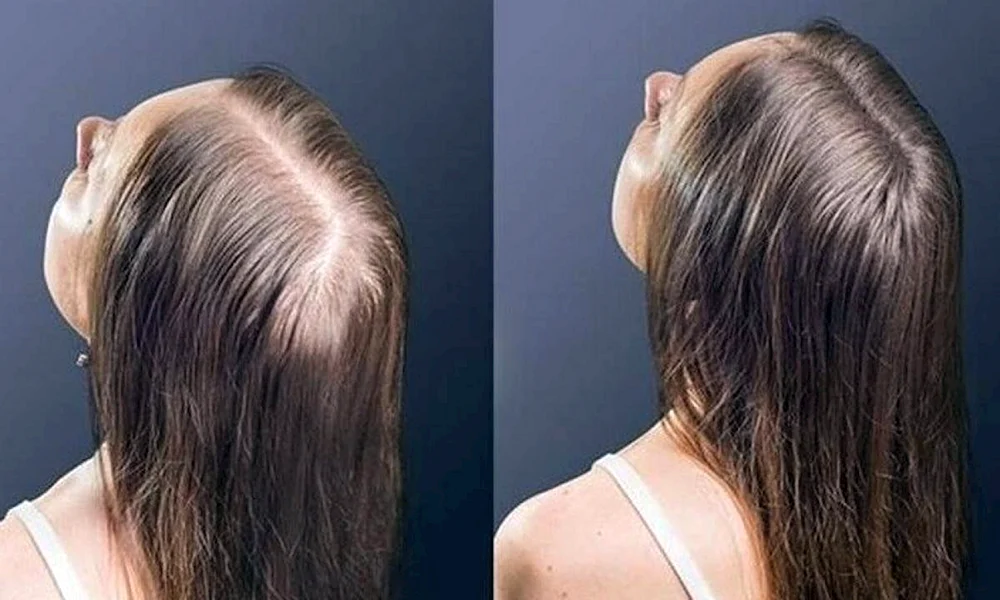 Schlechtes Haar bei Frauen