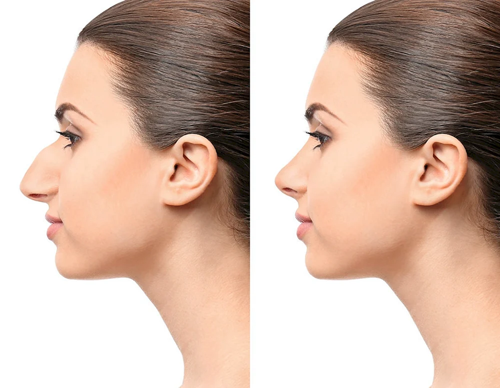 Rinoplastik