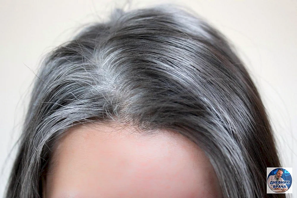 Frühes Ergrauen der Haare