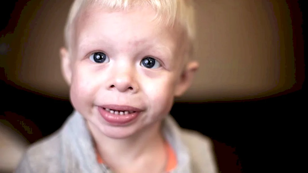 Williams Syndrom Elfengesicht