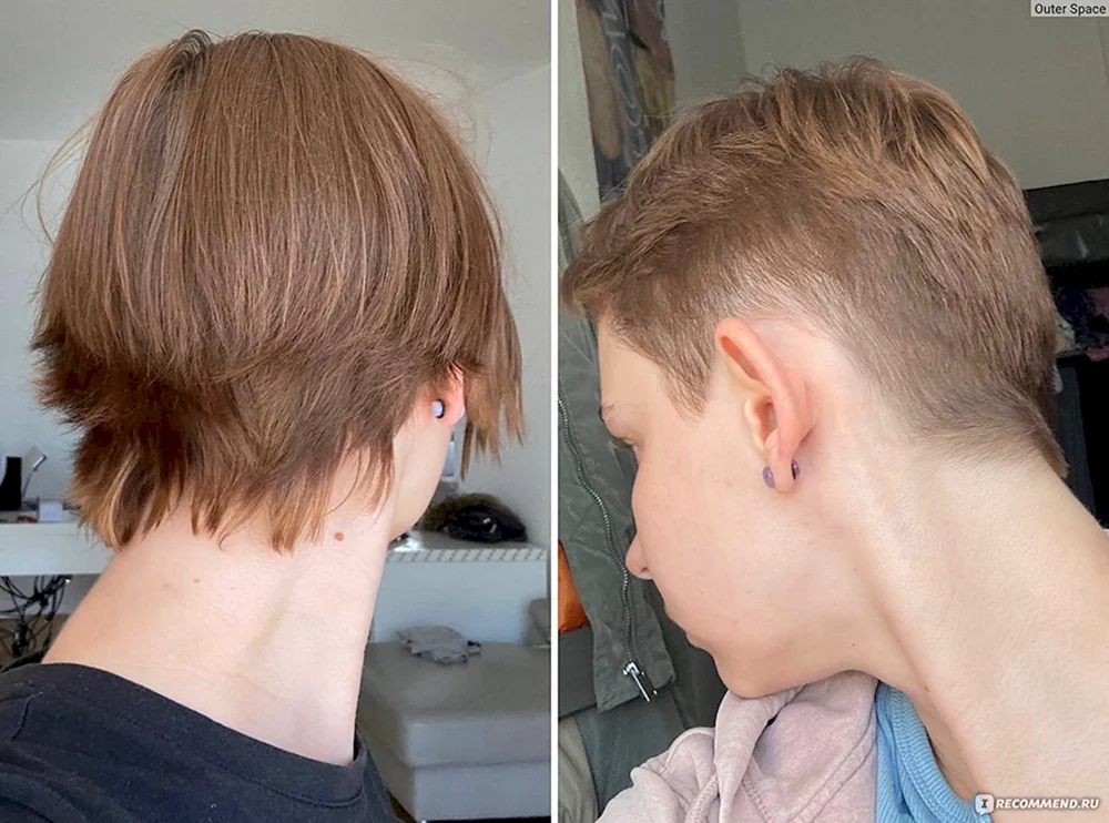 Monate alt nach Haartransplantation