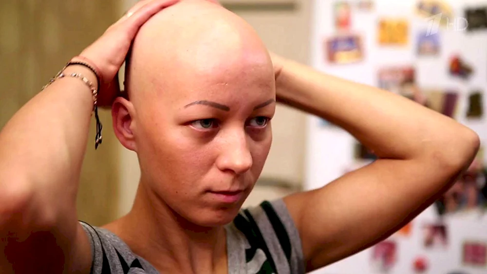 Totale Alopezie bei Frauen