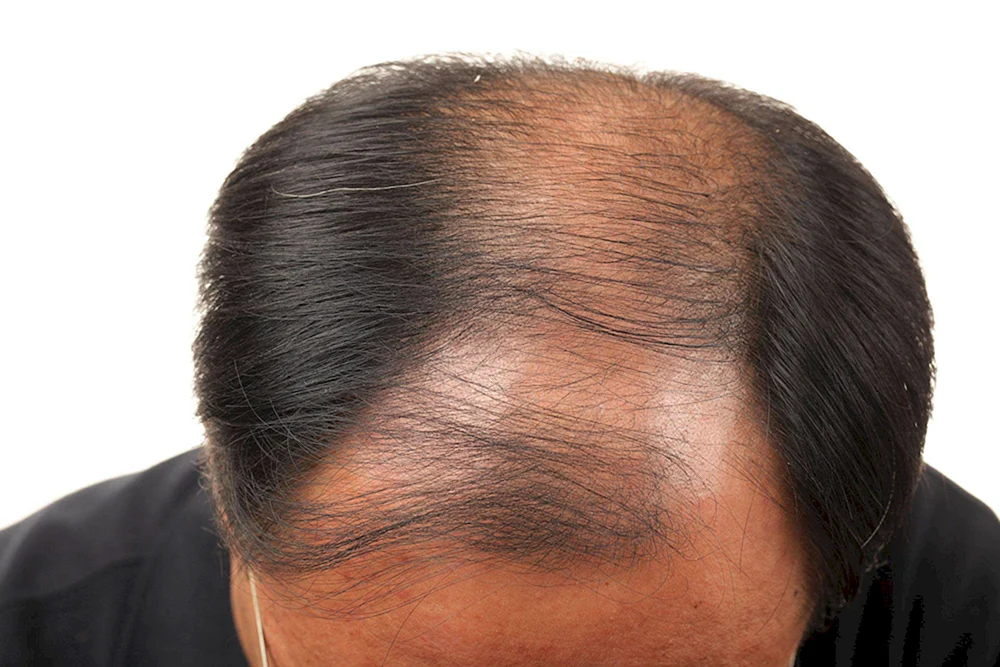 Kahles Haar